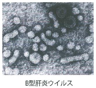 B型肝炎ウイルス